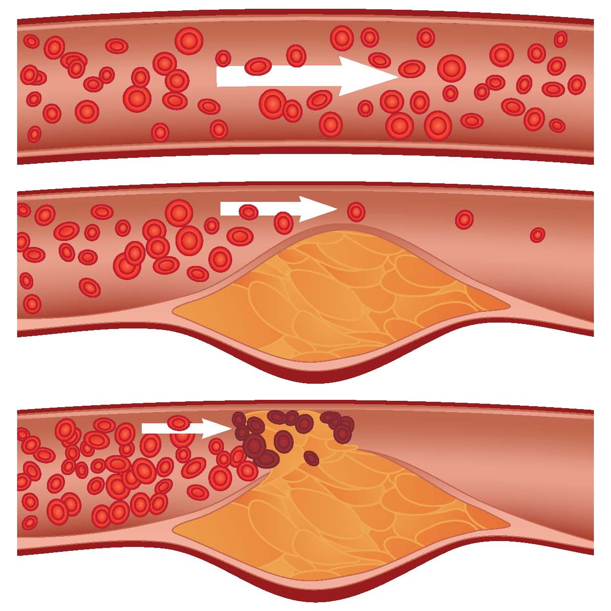 atherosclerosis-science-figure