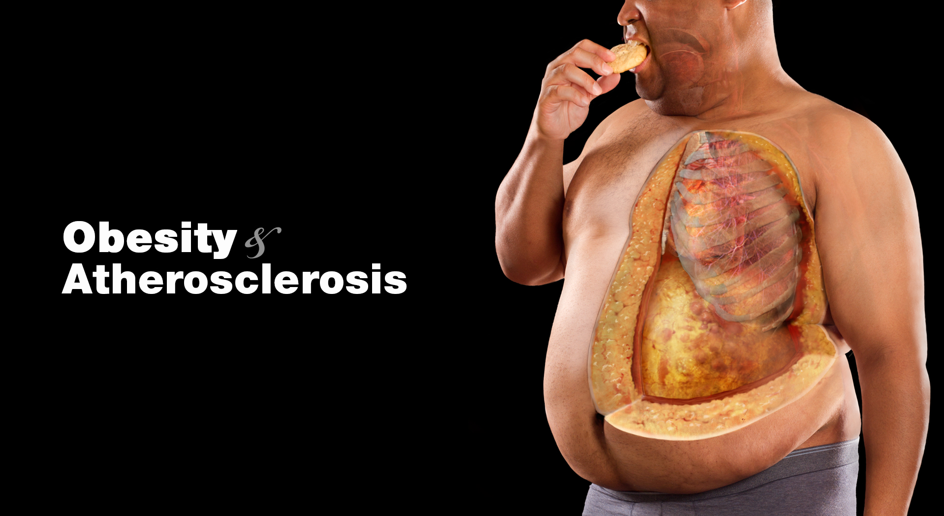 obesity_athero